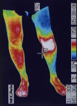 ACL Injury | Load Distribution Check