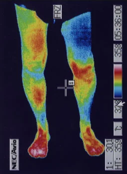 Causes of ACL injury｜Thermography showing reduced knee inflammation after treatment