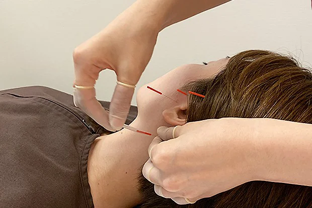 Acupuncture Treatment for MSA