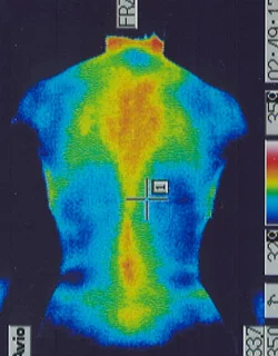 Baseball Elbow｜Back Temperature Distribution (Before Treatment)