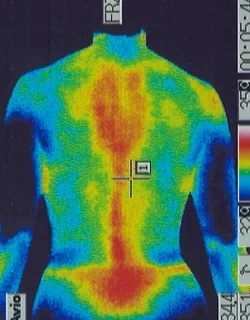 Pelvic Misalignment｜Back Temperature Distribution (After Treatment)